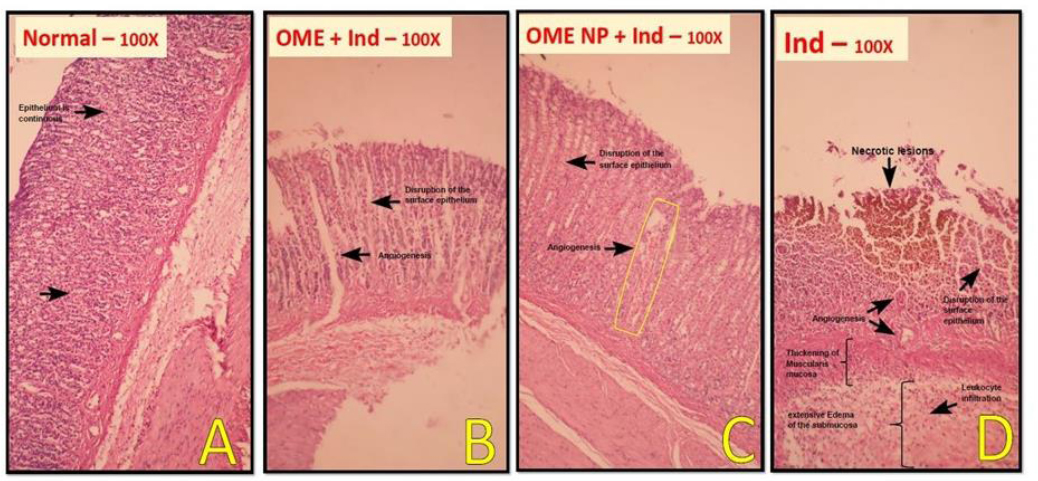 Microscopic evaluation of gastric tissue injuries induced by indomethacin in rats.正常组织胃溃疡引治胃溃疡诱导并用emeropal加载纳米粒子处理和D胃溃疡诱导并接收正常盐碱Stomach ulcer formation induced by indomethacin.